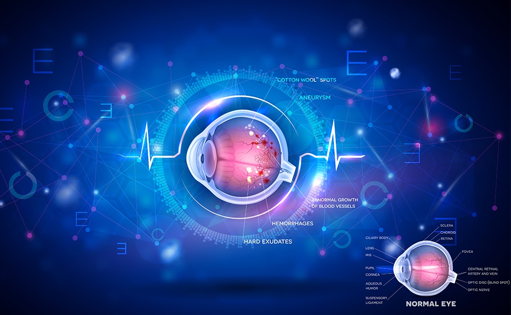 What Is Diabetic Retinopathy?